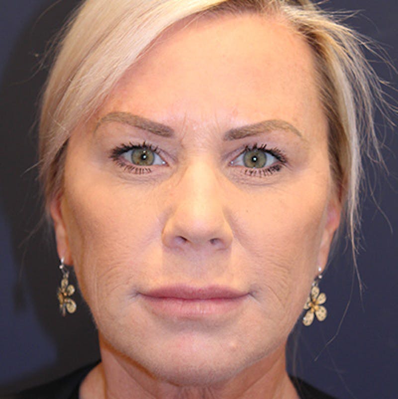Injectables Before & After Gallery - Patient 200297633 - Image 1