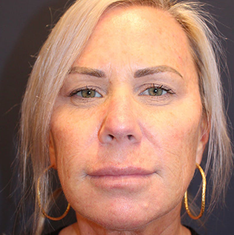 Injectables Before & After Gallery - Patient 200297633 - Image 2
