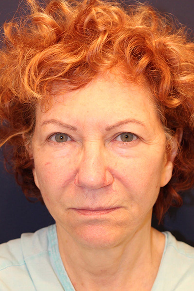 Necklift Before & After Gallery - Patient 535155 - Image 1