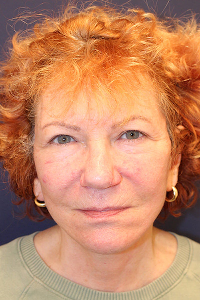 Facial Fat Graft Before & After Gallery - Patient 279591 - Image 2