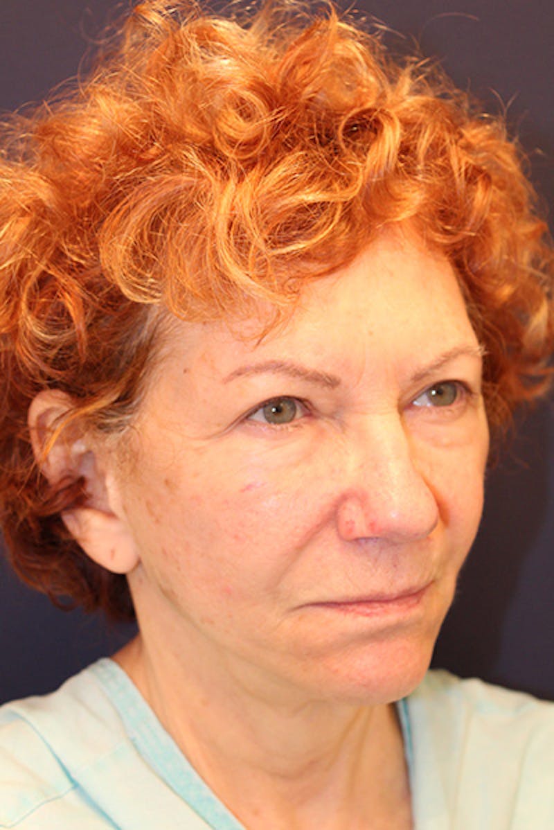 Facelift Before & After Gallery - Patient 502342 - Image 3