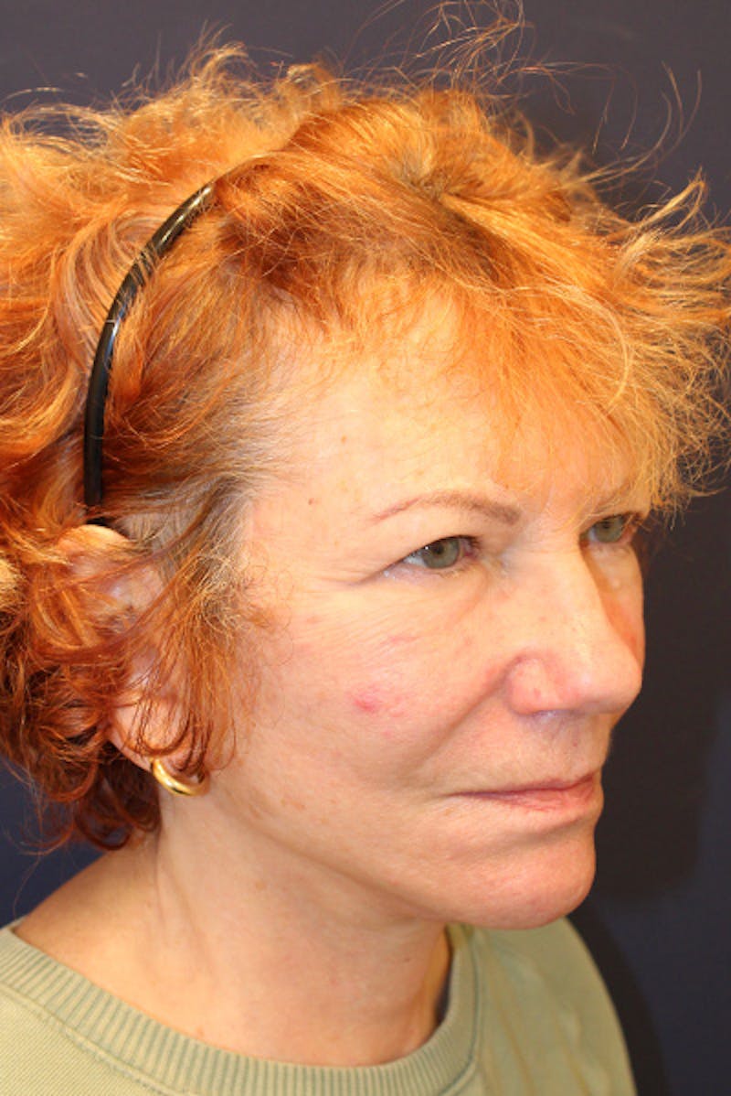 Facelift Before & After Gallery - Patient 502342 - Image 4