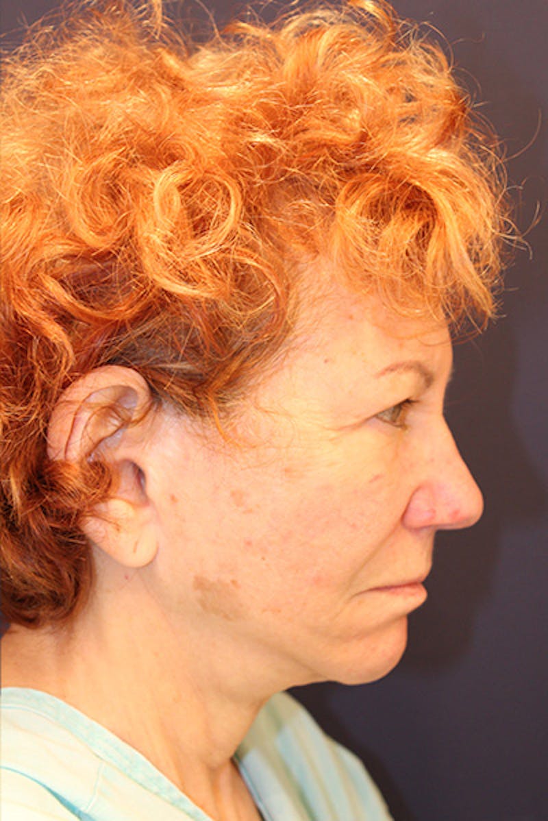 Facial Fat Graft Before & After Gallery - Patient 279591 - Image 5