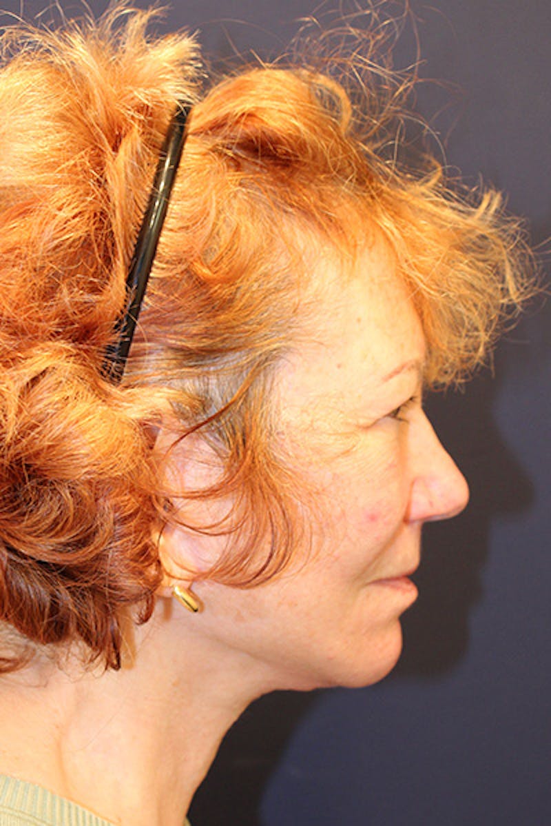 Necklift Before & After Gallery - Patient 535155 - Image 6