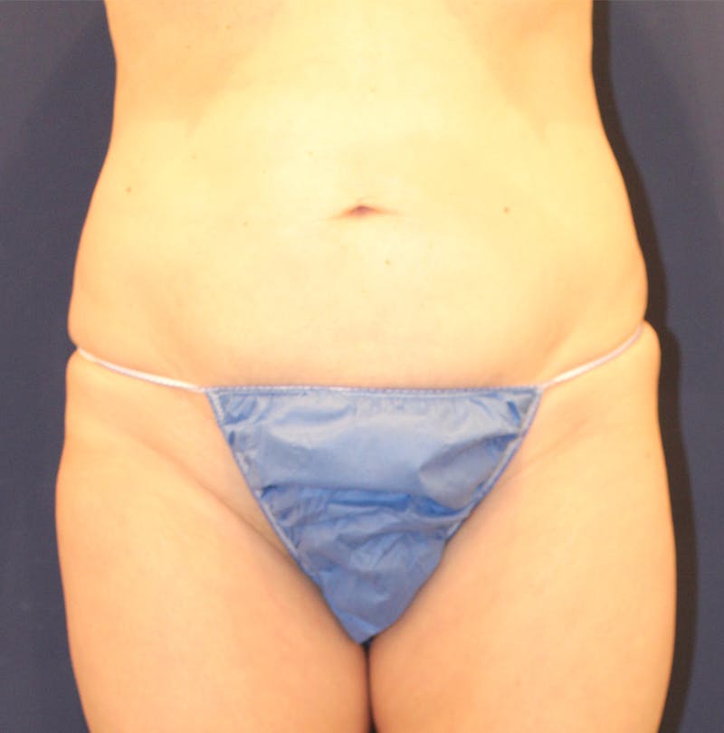 Tummy Tuck Before & After Gallery - Patient 169293 - Image 1