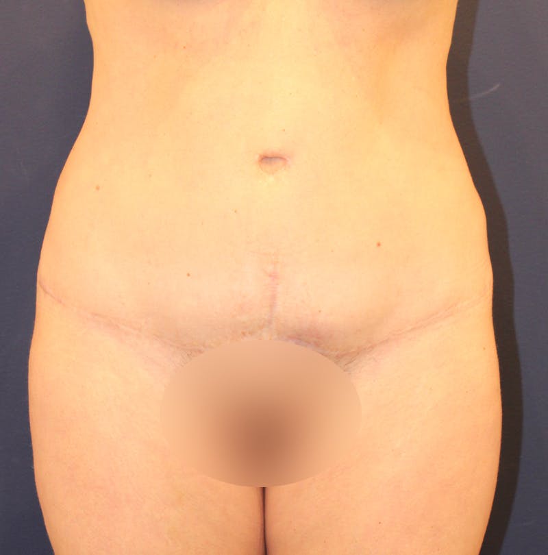 Tummy Tuck Before & After Gallery - Patient 169293 - Image 2