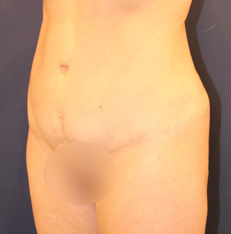 Tummy Tuck Before & After Gallery - Patient 169293 - Image 4