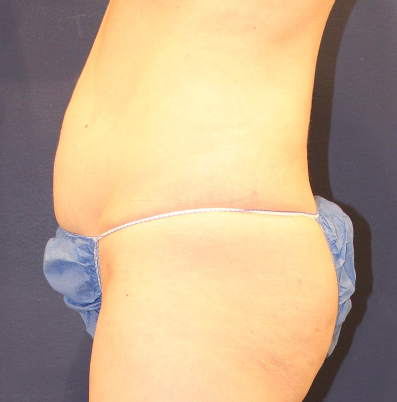 Tummy Tuck Before & After Gallery - Patient 169293 - Image 5
