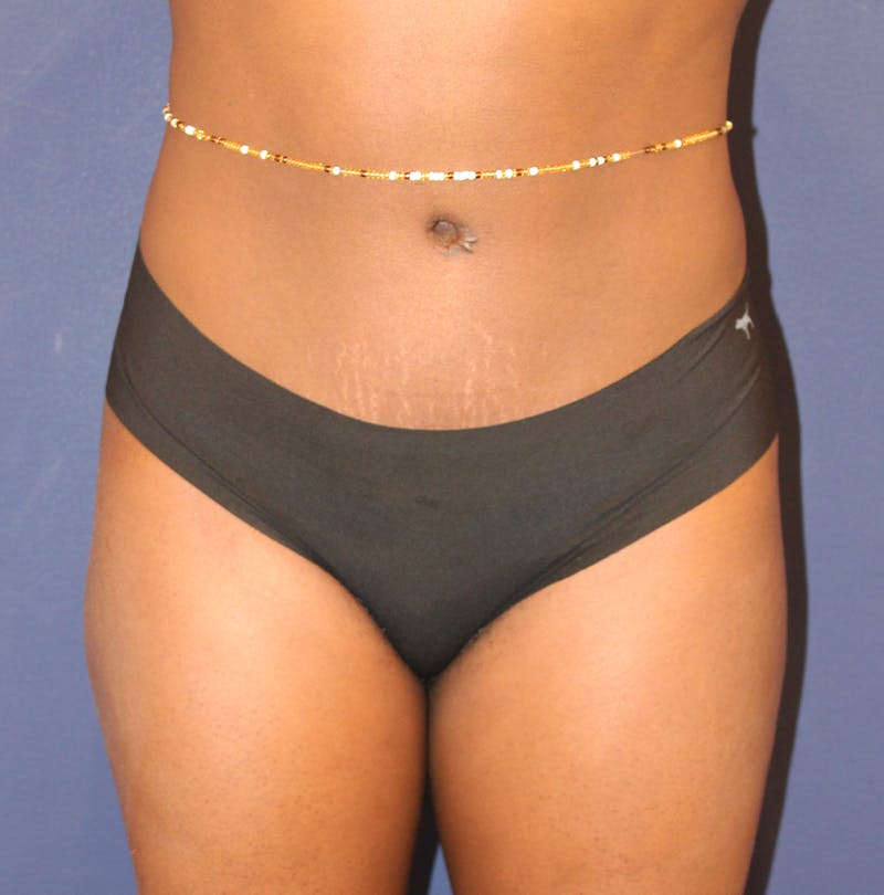 Tummy Tuck Before & After Gallery - Patient 209879 - Image 2