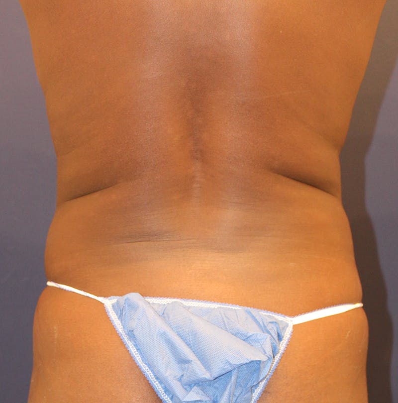 Tummy Tuck Before & After Gallery - Patient 209879 - Image 7