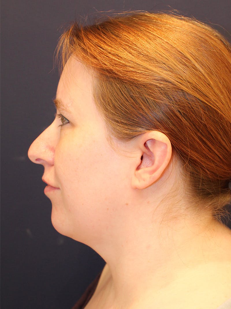 Neck Liposuction Before & After Gallery - Patient 357730 - Image 6