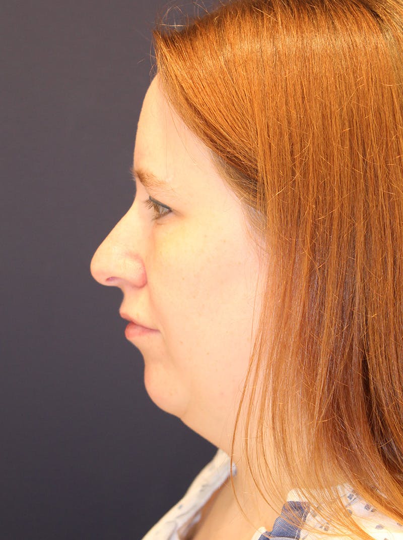 Neck Liposuction Before & After Gallery - Patient 357730 - Image 5