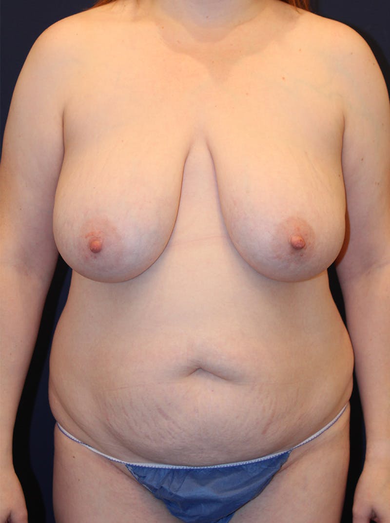 Mommy Makeover Before & After Gallery - Patient 174163303 - Image 1