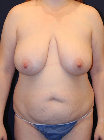 Mommy Makeover Before & After Gallery - Patient 174163303 - Image 1