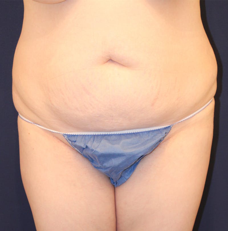 Tummy Tuck Before & After Gallery - Patient 198283789 - Image 1