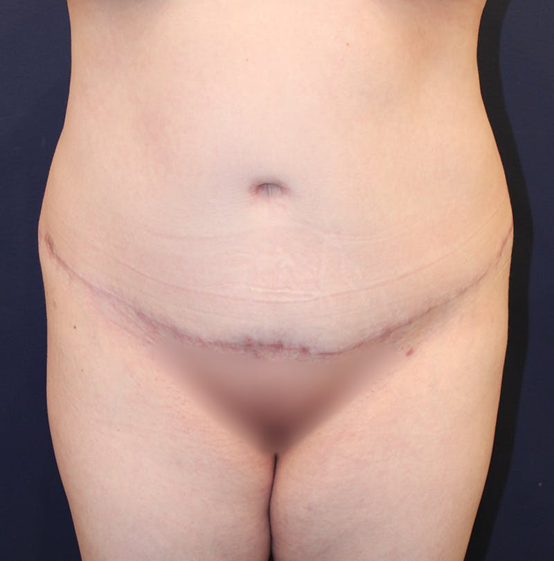 Tummy Tuck Before & After Gallery - Patient 198283789 - Image 2