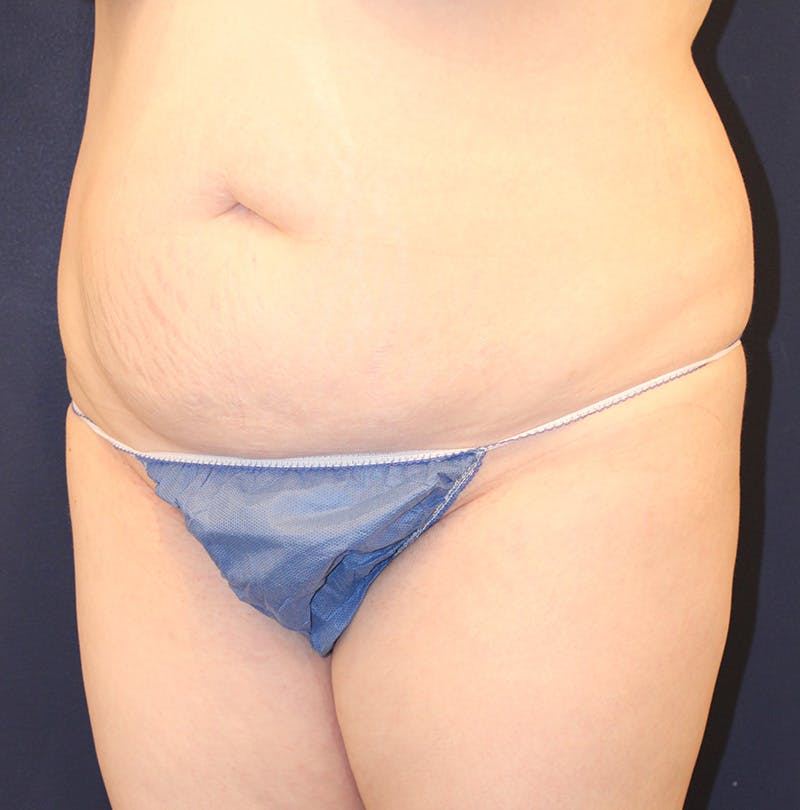 Tummy Tuck Before & After Gallery - Patient 198283789 - Image 3