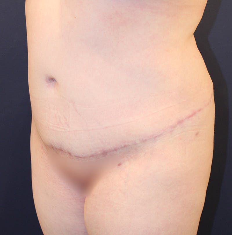 Tummy Tuck Before & After Gallery - Patient 198283789 - Image 4