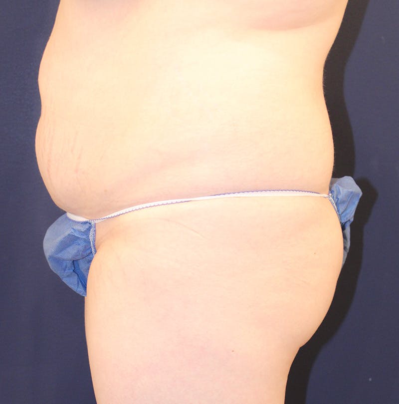 Tummy Tuck Before & After Gallery - Patient 198283789 - Image 5