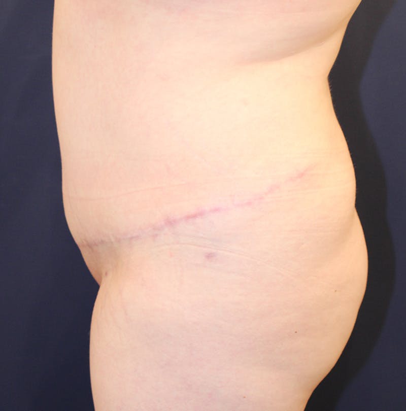 Tummy Tuck Before & After Gallery - Patient 198283789 - Image 6