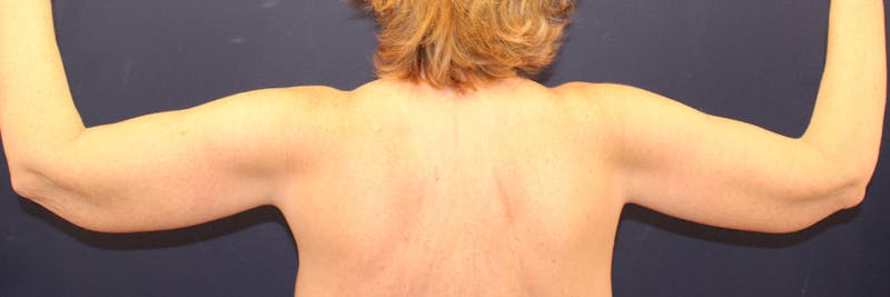 Arm Lift Before & After Gallery - Patient 118521 - Image 2