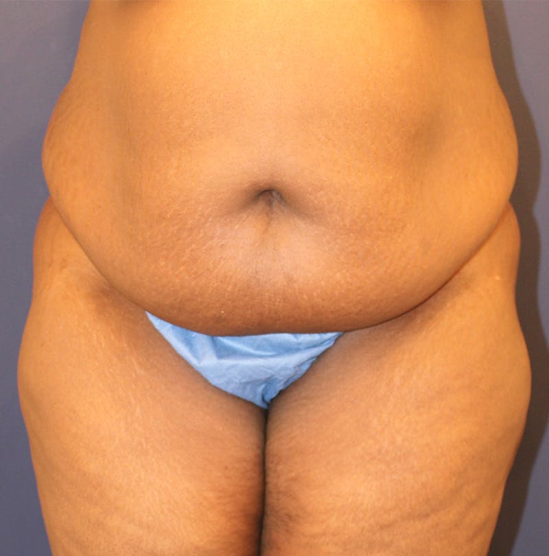 Tummy Tuck Before & After Gallery - Patient 174163257 - Image 1
