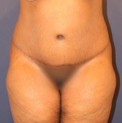 Tummy Tuck Before & After Gallery - Patient 174163257 - Image 2