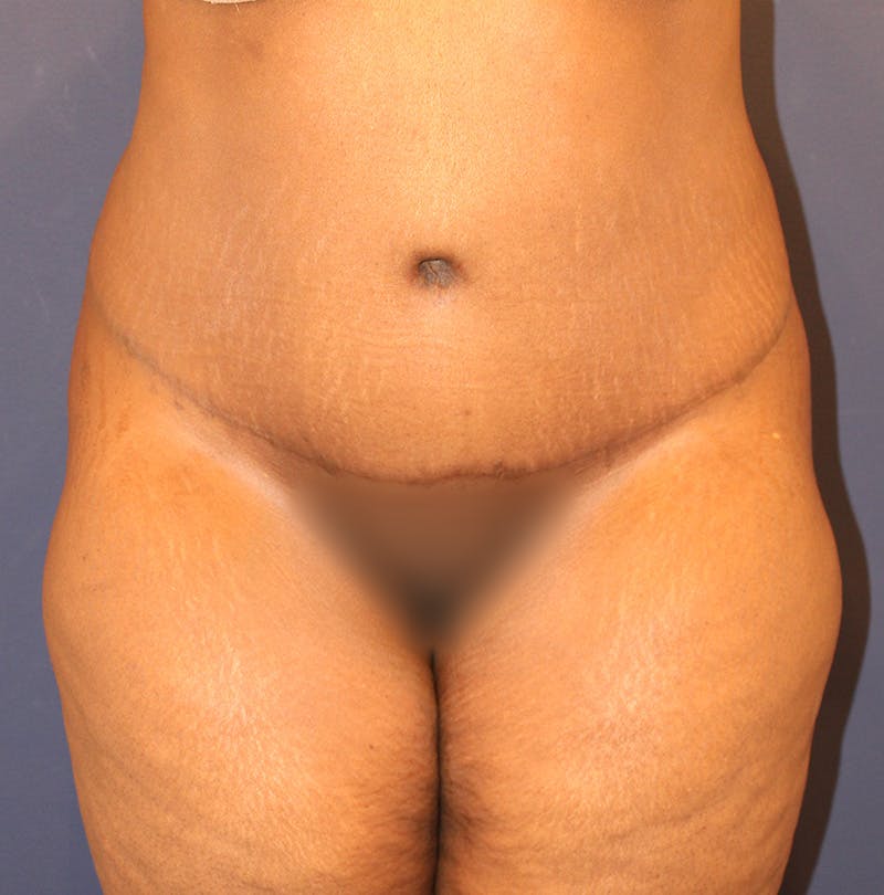 Tummy Tuck Before & After Gallery - Patient 174163257 - Image 2
