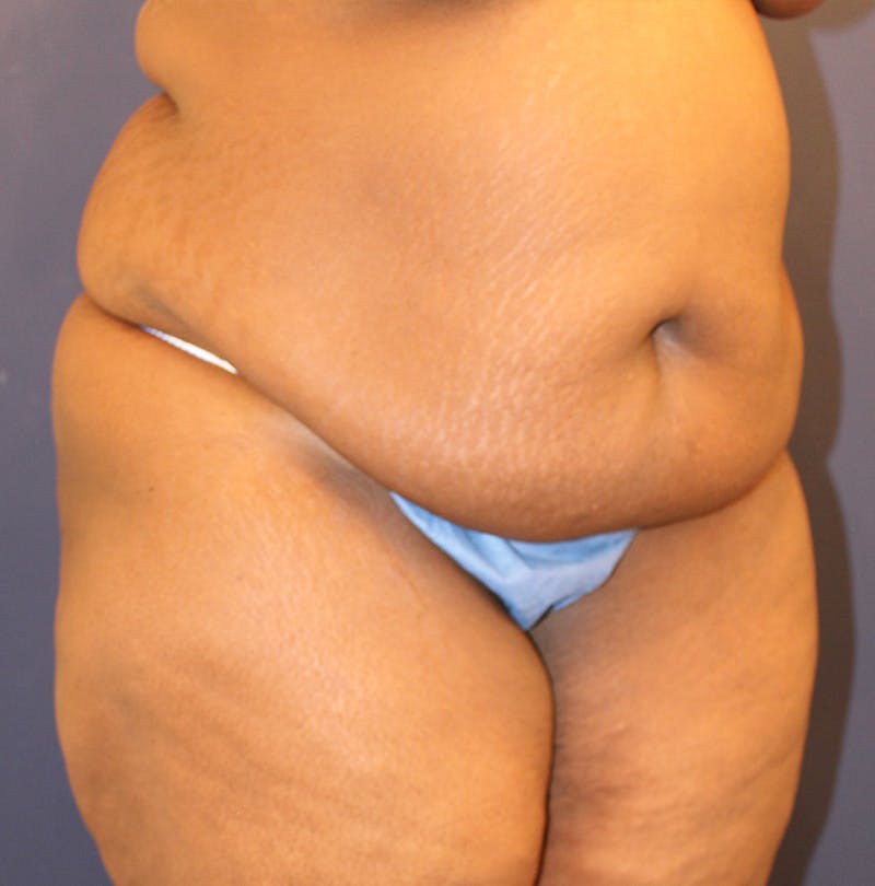 Tummy Tuck Before & After Gallery - Patient 174163257 - Image 3