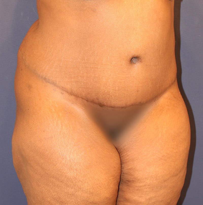 Tummy Tuck Before & After Gallery - Patient 174163257 - Image 4