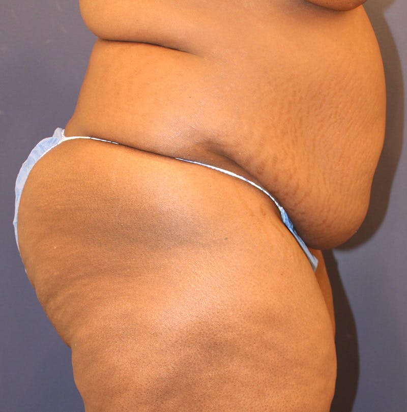Tummy Tuck Before & After Gallery - Patient 174163257 - Image 5