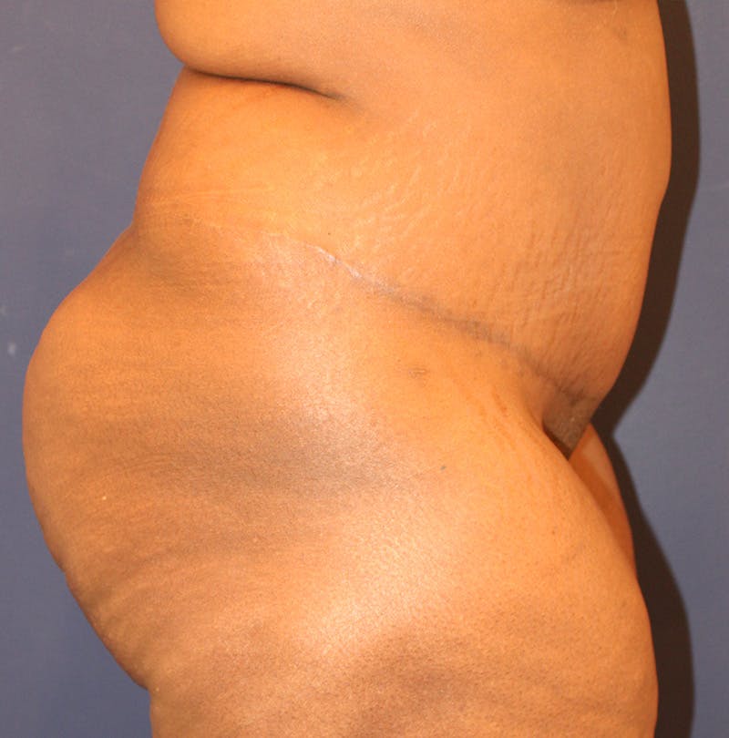 Tummy Tuck Before & After Gallery - Patient 174163257 - Image 6