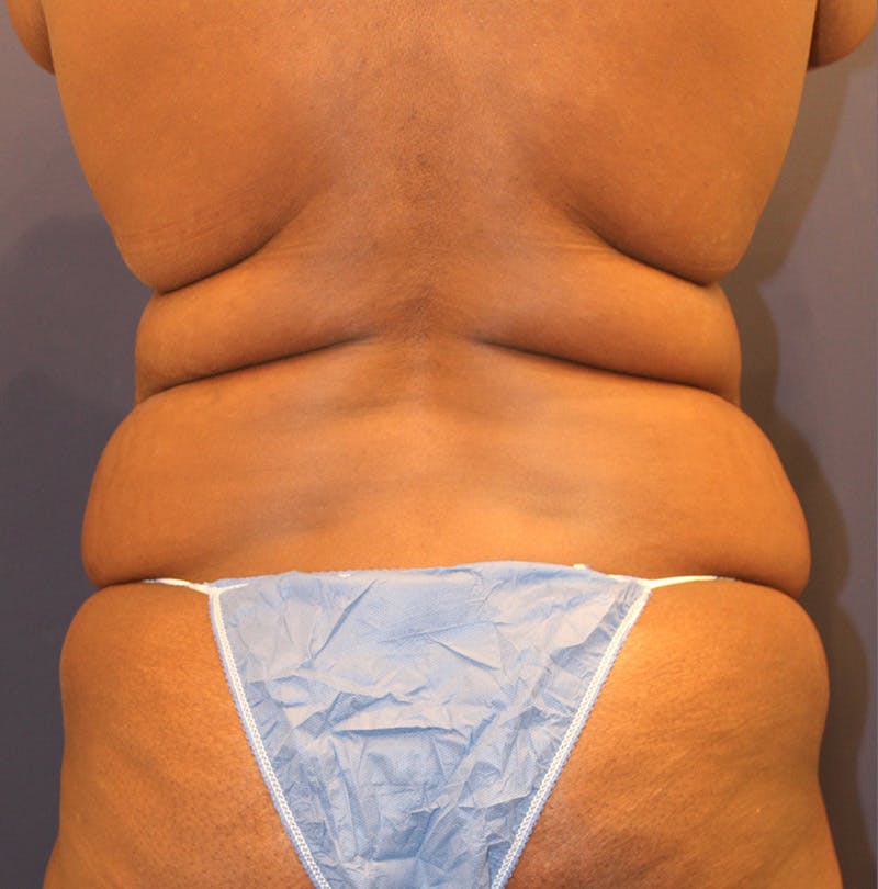 Tummy Tuck Before & After Gallery - Patient 174163257 - Image 7
