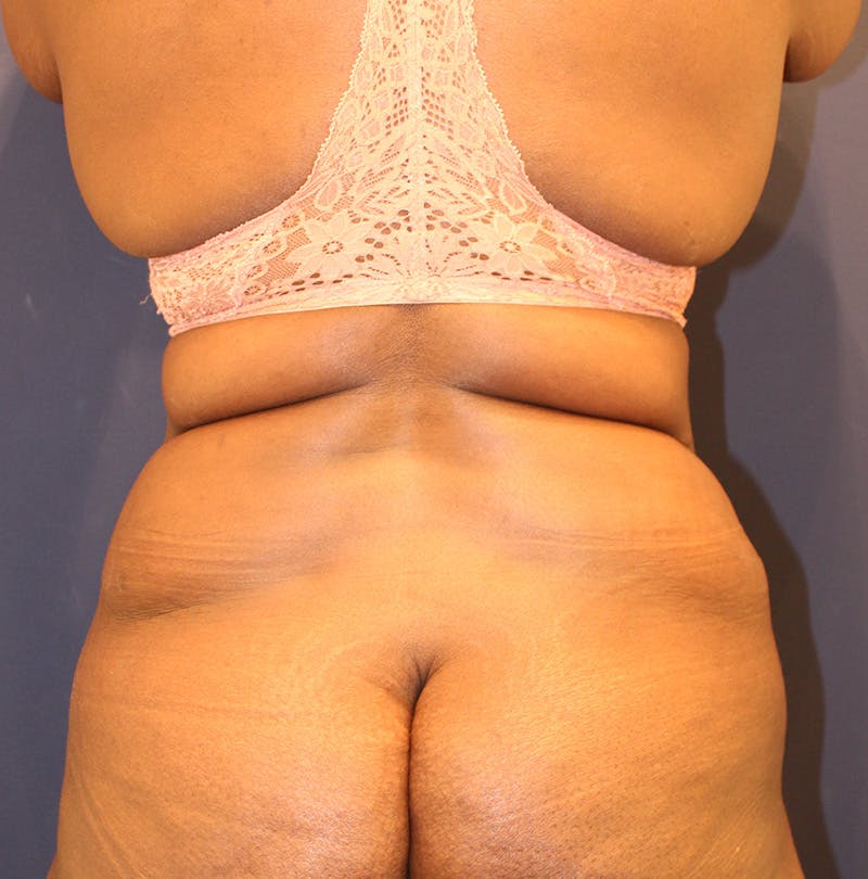 Tummy Tuck Before & After Gallery - Patient 174163257 - Image 8