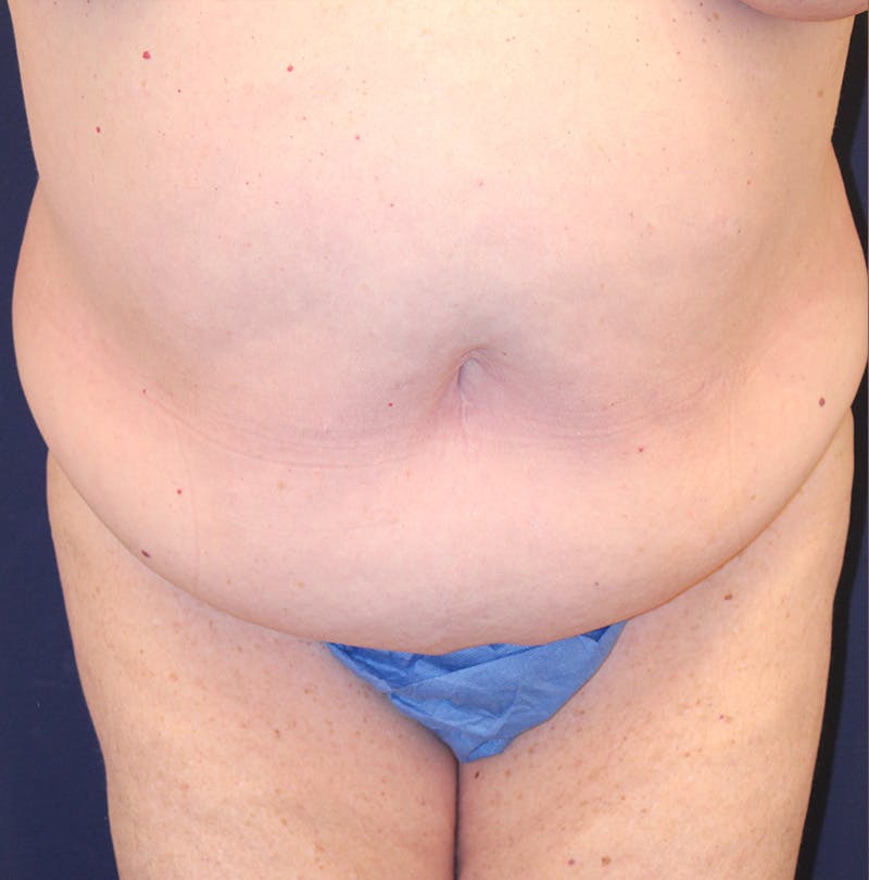 Tummy Tuck Before & After Gallery - Patient 174163179 - Image 1