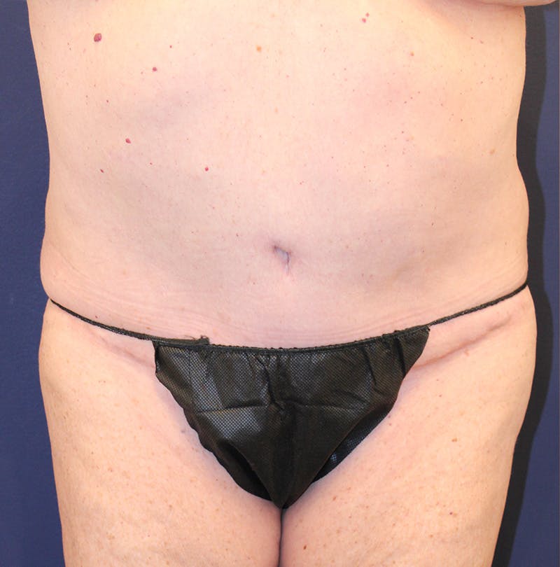 Tummy Tuck Before & After Gallery - Patient 174163179 - Image 2