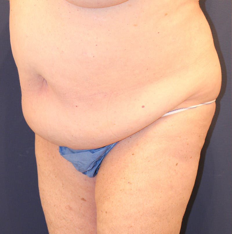 Tummy Tuck Before & After Gallery - Patient 174163179 - Image 3