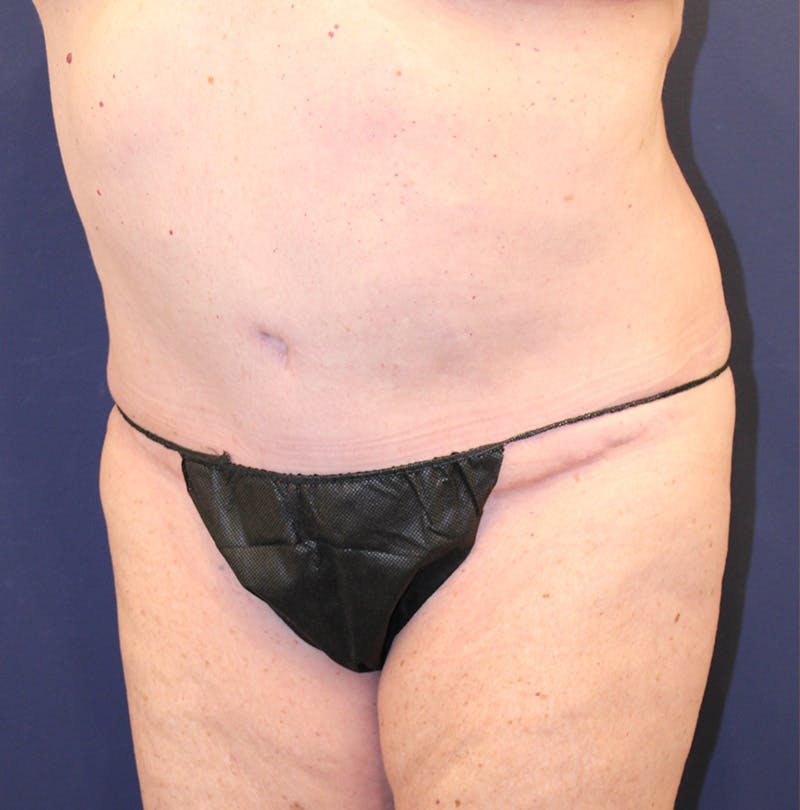 Tummy Tuck Before & After Gallery - Patient 174163179 - Image 4