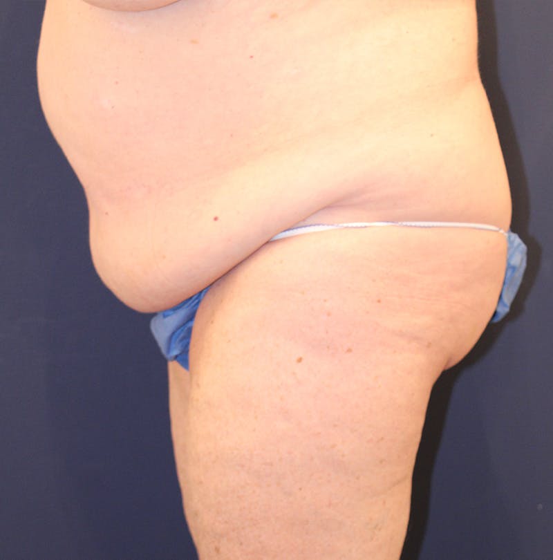 Tummy Tuck Before & After Gallery - Patient 174163179 - Image 5