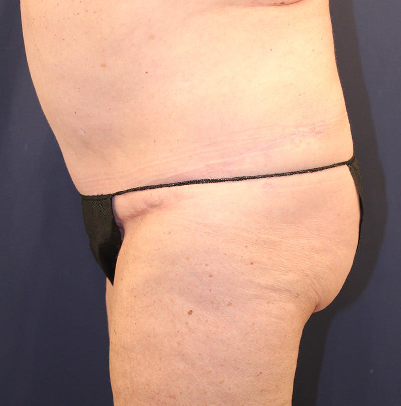 Tummy Tuck Before & After Gallery - Patient 174163179 - Image 6