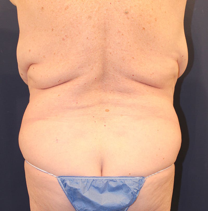 Tummy Tuck Before & After Gallery - Patient 174163179 - Image 7
