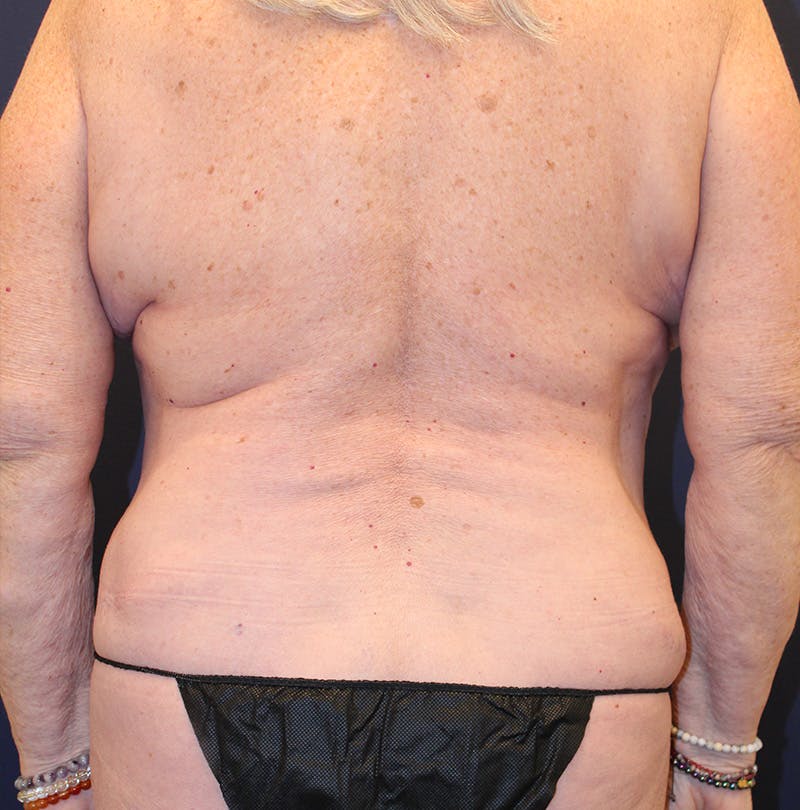 Tummy Tuck Before & After Gallery - Patient 174163179 - Image 8