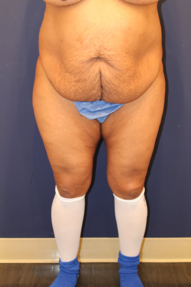 Tummy Tuck Before & After Gallery - Patient 429390 - Image 1