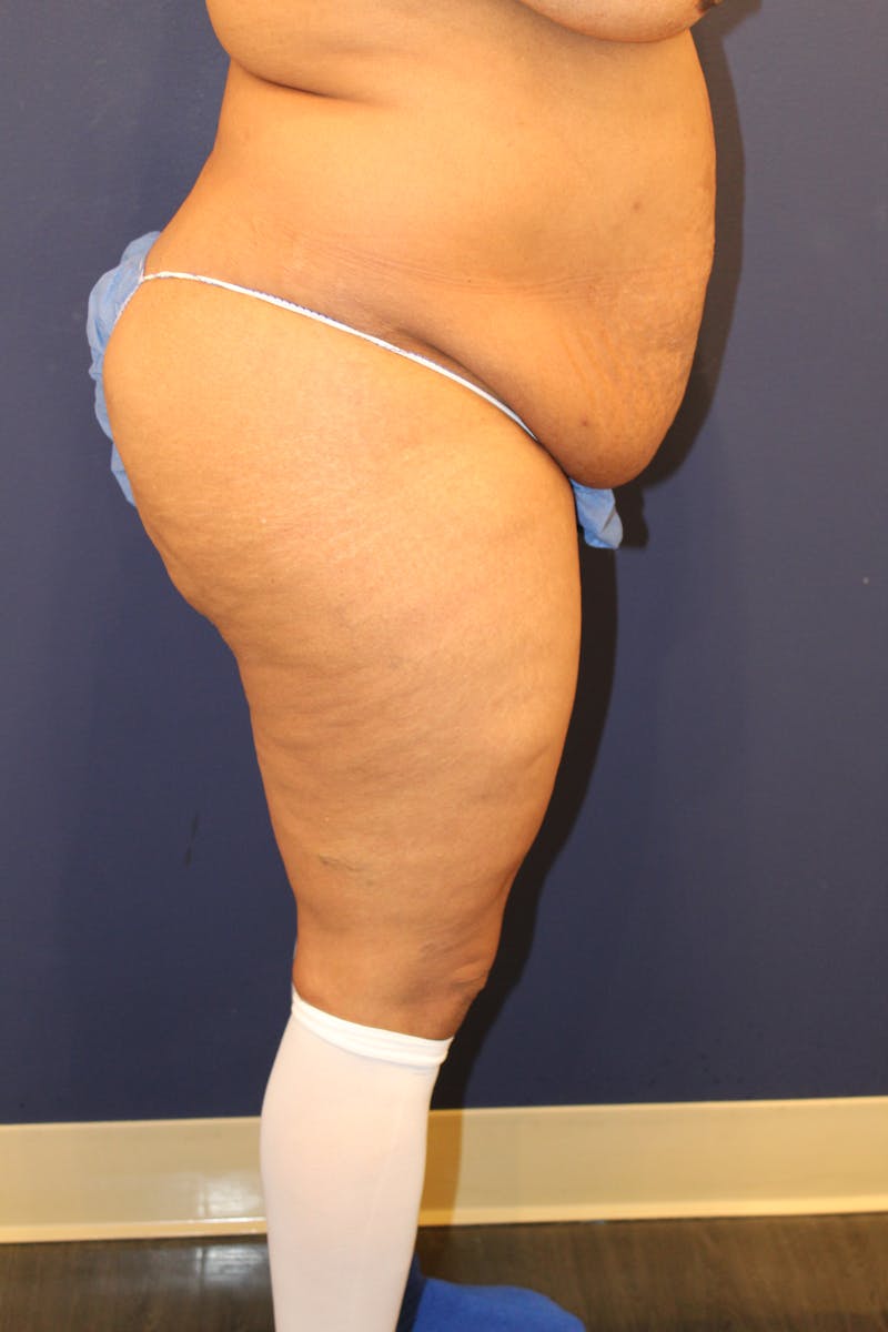 Tummy Tuck Before & After Gallery - Patient 429390 - Image 5