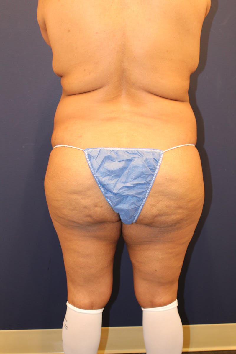 Tummy Tuck Before & After Gallery - Patient 429390 - Image 7