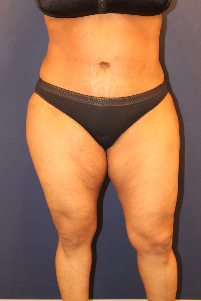 Tummy Tuck Before & After Gallery - Patient 429390 - Image 2