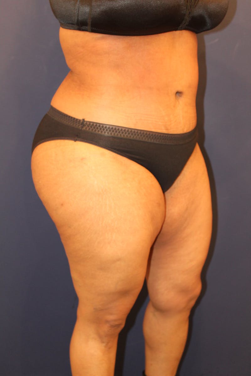 Tummy Tuck Before & After Gallery - Patient 429390 - Image 4