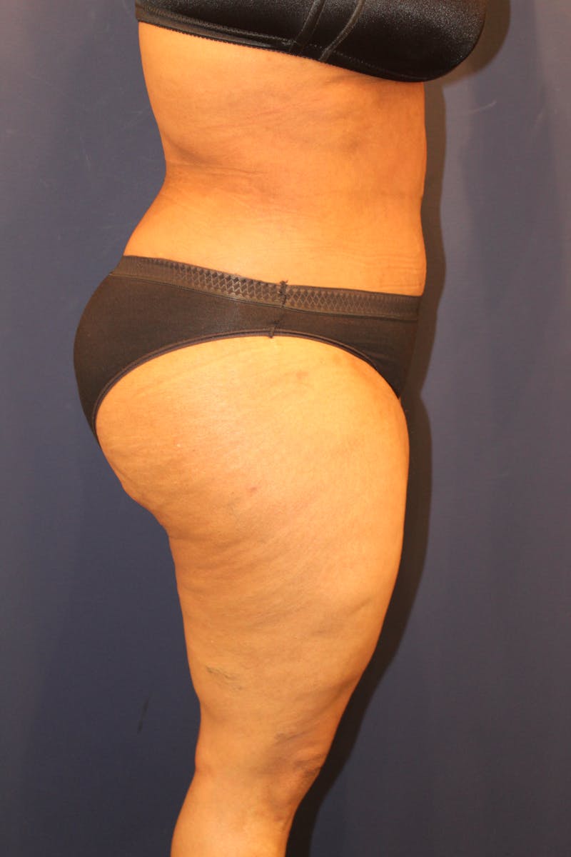 Tummy Tuck Before & After Gallery - Patient 429390 - Image 6