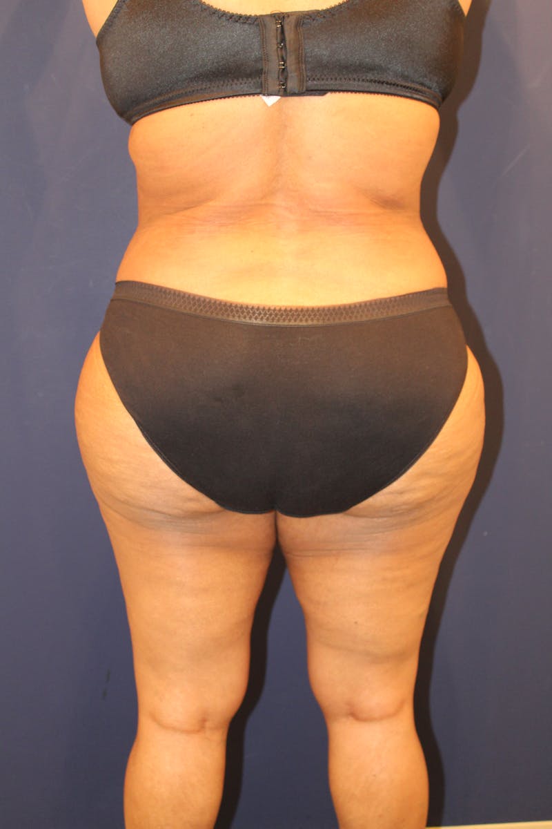 Tummy Tuck Before & After Gallery - Patient 429390 - Image 8