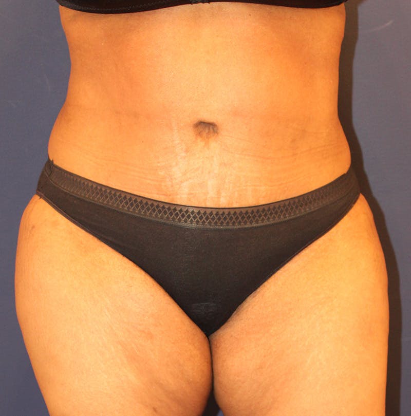 Tummy Tuck Before & After Gallery - Patient 770134 - Image 2